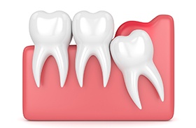 Simple illustration of impacted wisdom tooth