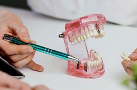 Dentist using model to explain dental implants