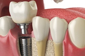 Illustration of dental implant in jawbone next to natural teeth