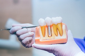 Dentist holding implant model, explaining implant treatment options