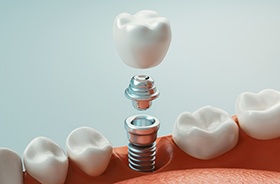 Illustration of single dental implant, abutment, and crown