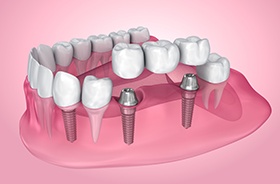 Illustration of three-unit dental implant bridge