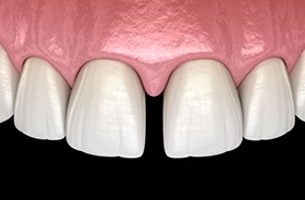 Close-up illustration of gap between front teeth
