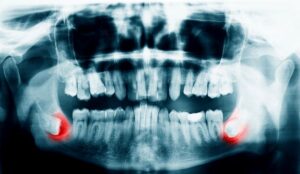 X-ray showing impacted wisdom teeth in lower dental arch